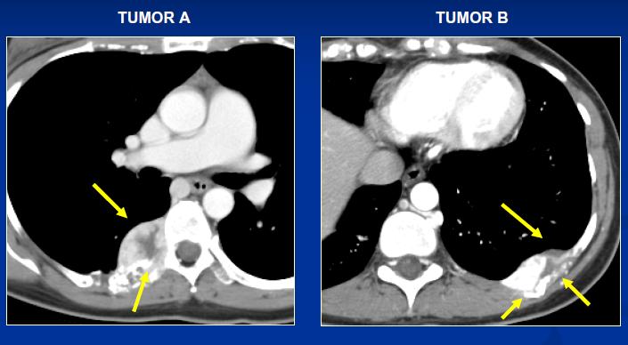 Aplicação Cryo Percutânea Matthew Callstrom, MD Mayo Clinic Metastases Ósseas Causada por duas lesões PAINFUL METASTATIC