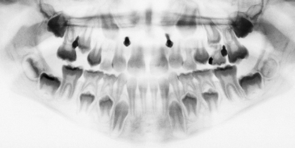 Mini-implantes em Ortodontia Conceitos Inovadores em Ancoragem Estabilidade primária Estabilidade com o osso Fig. 4-1 Ancoragem monocortical. Fig. 4-2 Estabilidade secundária do mini-implante: ilustração após período de inserção.