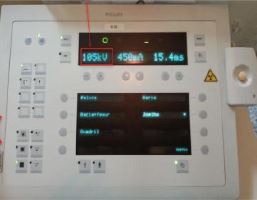 Como saber a Kv? Utilizando a fórmula de Mikissú: Kv = 2.