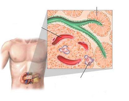 Diabetes Tipo I Causa: Redução das células β do pâncreas, o que leva a uma diminuição da produção de