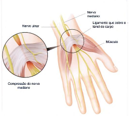 29 A STC é uma das patologias mais comuns relacionadas com as LER lesões por esforços repetitivos, ou DORT distúrbios osteomusculares relacionados ao trabalho, essa lesão resulta da compressão do