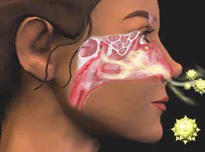 Rinites alérgicas e ou crônicas: É uma inflamação não contagiosa das mucosas do nariz, que aparece de forma recorrente Nariz escorrendo, coceira nos olhos, no nariz e na boca, espirros e,
