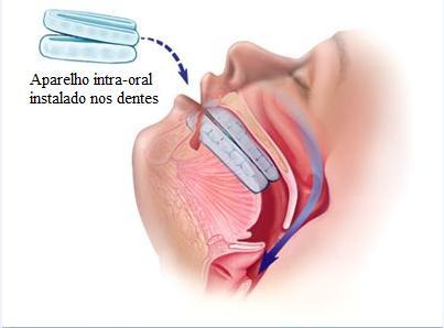 Terapêutica da SAOS Outras medidas terapêuticas o Medidas gerais o Perda de peso o Redução do consumo de álcool o Terapia posicional o Medidas de higiene do sono o Tratar