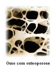 Osteoporose Desordem esquelética Redução da densidade mineral óssea (DMO)