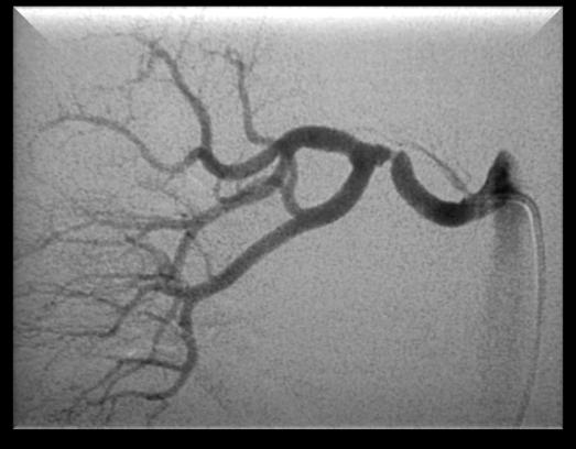 Estenose Arterial Renal Fibrodisplasia (10%) D.