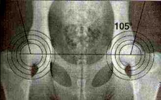 Poderão estar presentes irregularidades ou apenas pequenos sinais de alterações osteoartrósicas da margem acetabular cranial, caudal ou dorsal ou na cabeça femorais D: displasia moderada. Subluxação.