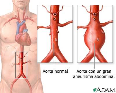 Aneurisma da aorta A aorta é a principal artéria do corpo.