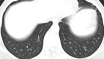 (janela pulmonar) Ligamento pulmonar inferior L