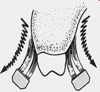 2- Técnica de Stillman modificada A escova é colocada com o longo eixo das cerdas lateralmente contra a gengiva, e as cerdas são deslizadas de gengival para oclusal.