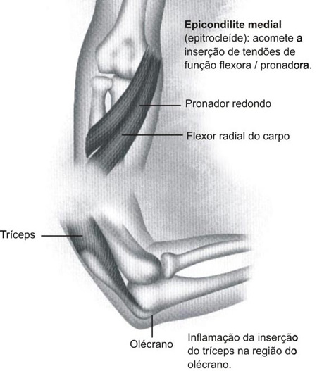 - Síndrome do Canal Cubital