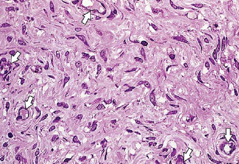 TECIDOS CONJUNTIVOS PROPRIAMENTE DITOS (TCPD) TCPD FROUXO Características: As células mais comuns são os fibroblastos e macrófagos; Consistência delicada, flexível e pouco resistente às trações tendo