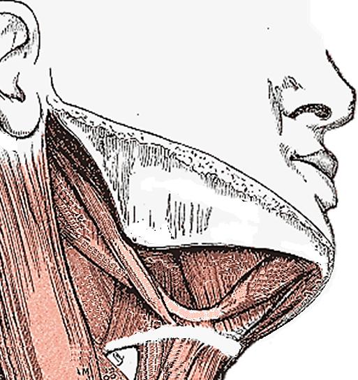 OPEN ACCESS ATLAS OF OTOLARYNGOLOGY, HEAD & NECK OPERATIVE SURGERY SIALADENECTOMIA SUBMANDIBULAR A exérese da glândula salivar submandibular (GSM) pode ser indicada por sialadenite crónica,