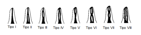 17 meio de microscópio de dissecção e classificados em oito tipos: Tipo I: Um único canal que se estende da câmara pulpar ao ápice; Tipo II: Dois canais deixam a câmara pulpar e se juntam próximo ao