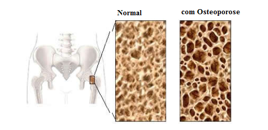 14 3.2 Tipos de Osteoporose renovam como deveriam, ficando cada vez mais fracos e finos e sujeitos a fraturas [33]. A Figura 3.