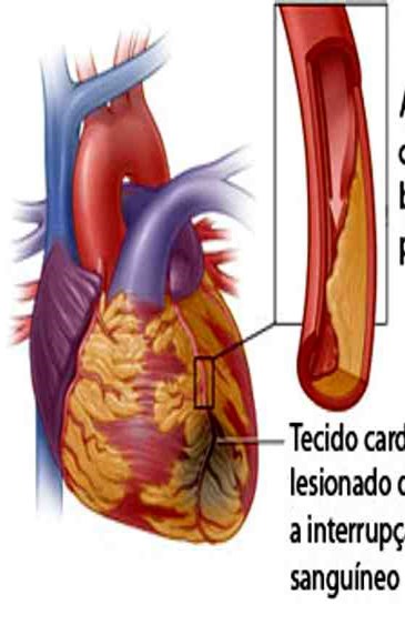 Doença Arterial Coronariana A DAC é a principal causa de mortalidade em países