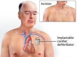 Cardiodesfibrilador Implantável Prevenção Primária CDI Adabag AS, Nature Rev, 2010 Prevenção
