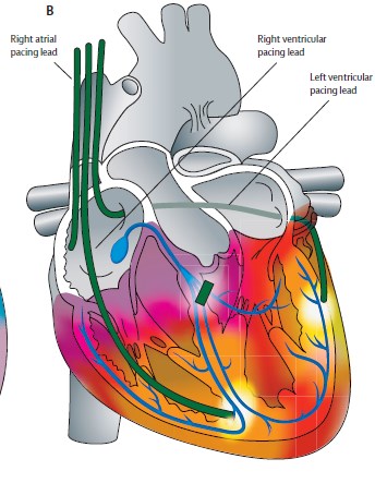 Terapia de Ressincronização Cardíaca TRC Holzmeister J, Lancet, 2011