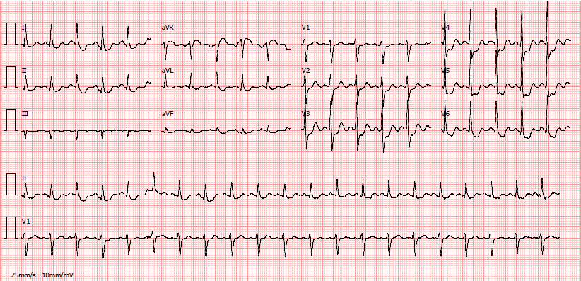 Síndrome coronária aguda Eletrocardiograma Infradesnivelamento do segmento ST ABC of Clinical Eletrocardiography