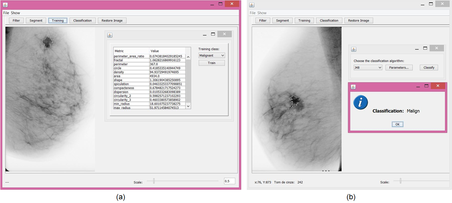 CAPÍTULO 4. METODOLOGIA E MAMOCAD 79 IBK e o Multilayer Perceptron (MLP). Na Figura 4.4(b) tem-se o resultado da classificação de uma ROI como maligna, utilizando o algoritmo de mineração J48.