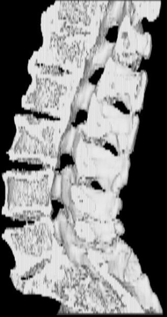 Osteófitos ou Bicos de papagaio