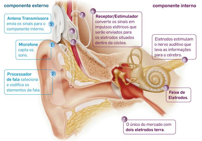 23 eletrodos, (6) os eletrodos estimulam o nervo auditivo.