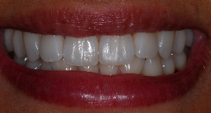 14 Depois o paciente deve estar com lábio em repouso e boca entreaberta, estando dessa vez de perfil, para que possa ser visualizado o posicionamento dos dentes e o volume dos lábios. Figura 2.