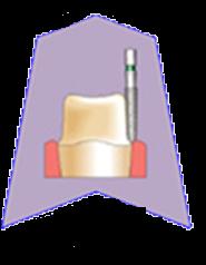 Realização do preparo dental pelo dentista.