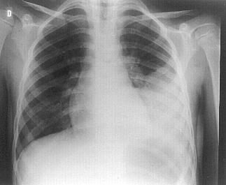 Pneumonias Lobares ou Segmentares - Homogeneamente um lobo, lobos ou segmentos pulmonares.