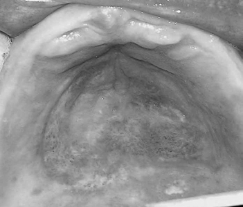 Como diagnóstico diferencial foram propostas hiperplasia palatina por câmara de sucção e fibroma, sendo escolhida como diagnóstico clínico a primeira opção.