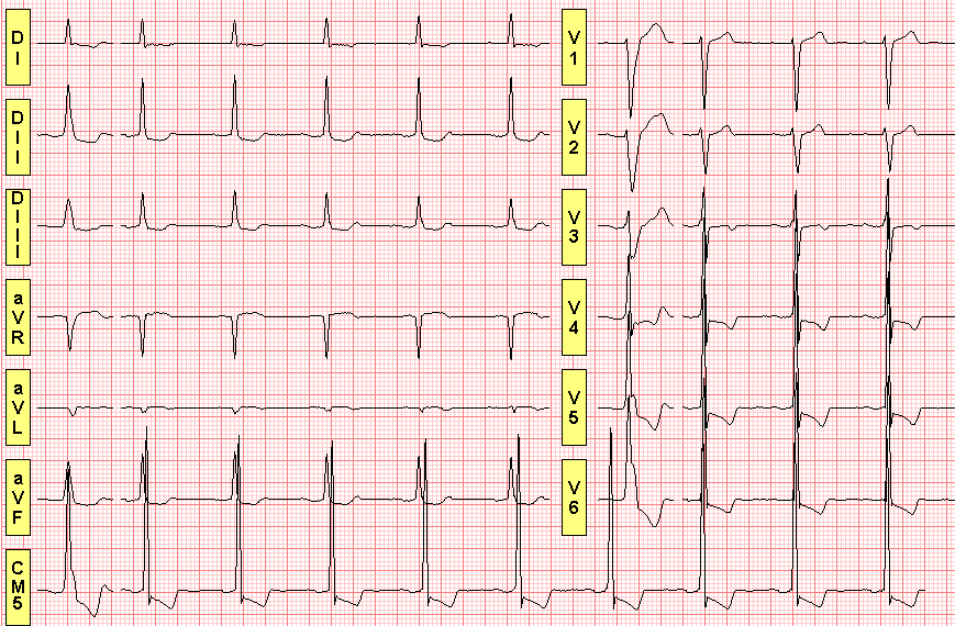 ECG Teste