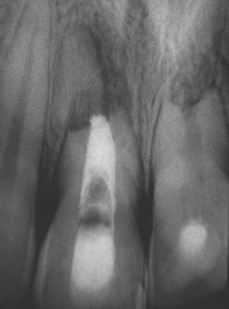 Espaço (do ligamento) periodontal: suas principais alterações radiográficas (FIGURA 12 a/12 b - 13 a/13 b) são: aumento ou redução de espessura e irregularidades na continuidade relacionadas a