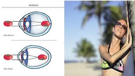 Os sentidos humanos Miopia É uma anomalia da visão que consiste em um alongamento do globo ocular.