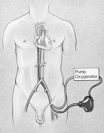 ECMO Oxigenação por