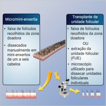 Tipos de transplantes Existe uma variedade de técnicas de transplante capilar e duas das técnicas mais populares hoje são conhecidas como transplantes de micro/mini-enxertia e unidade folicular.