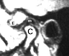 Ressonância Magnética (RM) RM normal da ATM mostrando um menisco normal (M) posterior e