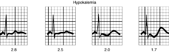 HIPOPOTASSEMIA - ECG HIPO K+