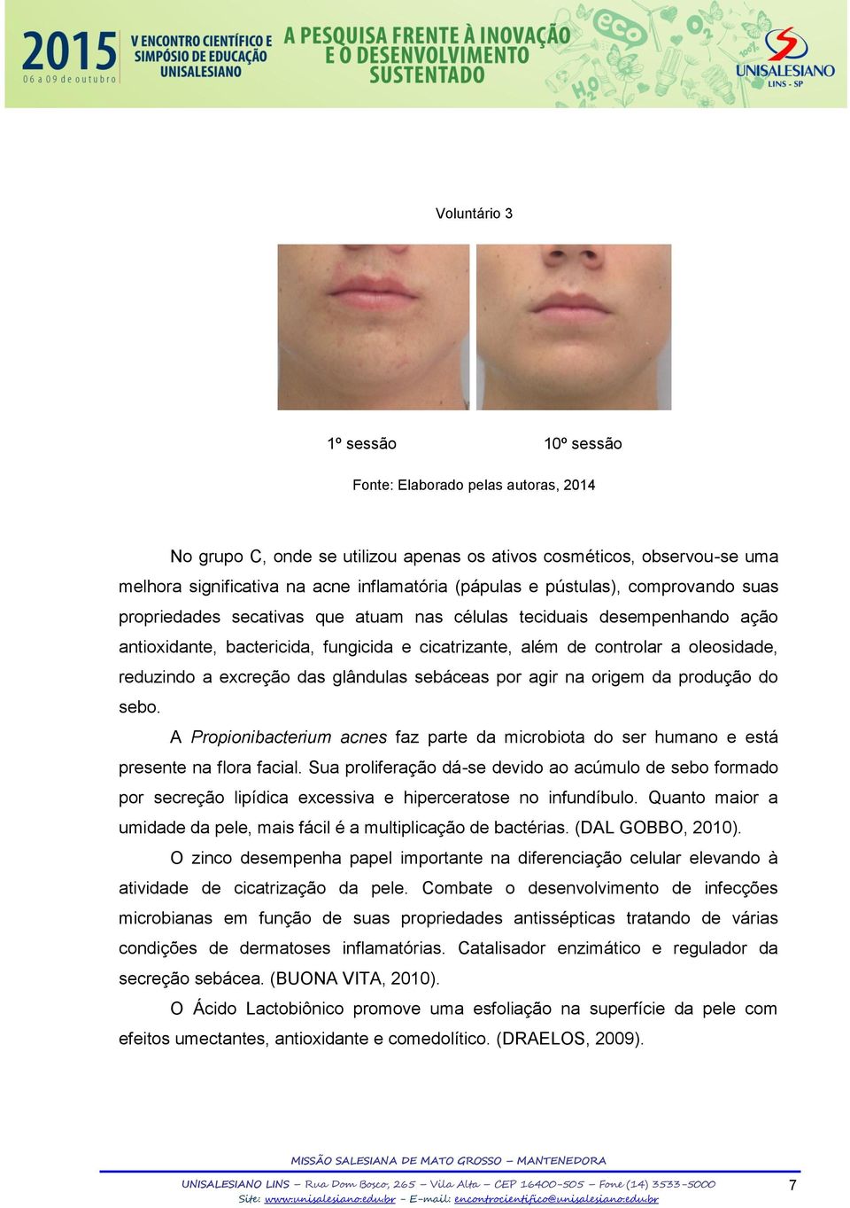 excreção das glândulas sebáceas por agir na origem da produção do sebo. A Propionibacterium acnes faz parte da microbiota do ser humano e está presente na flora facial.