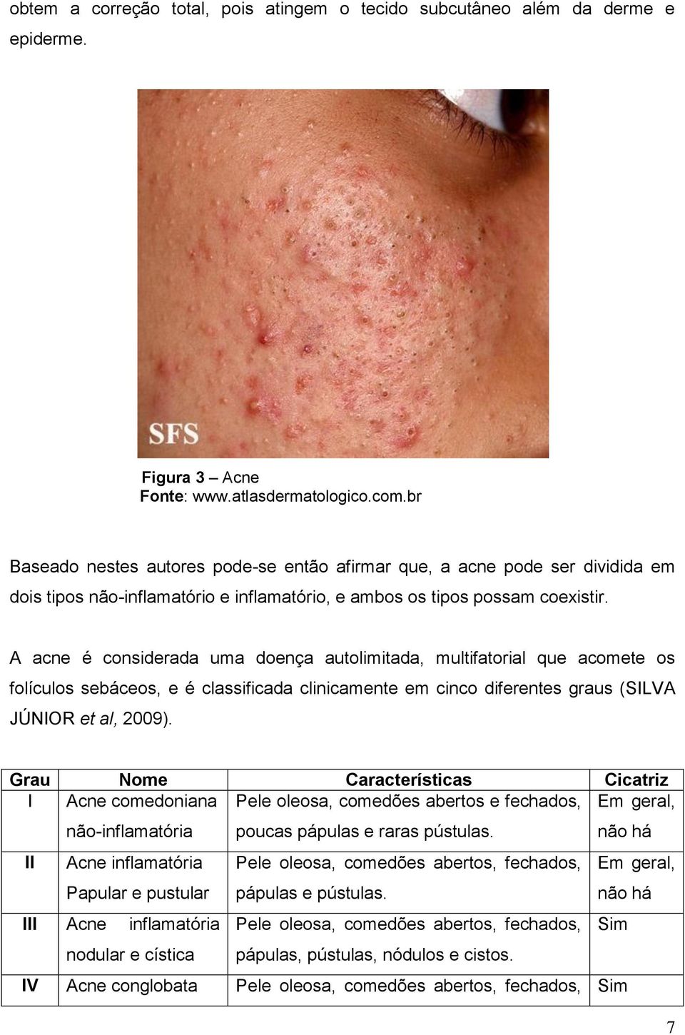 A acne é considerada uma doença autolimitada, multifatorial que acomete os folículos sebáceos, e é classificada clinicamente em cinco diferentes graus (SILVA JÚNIOR et al, 2009).