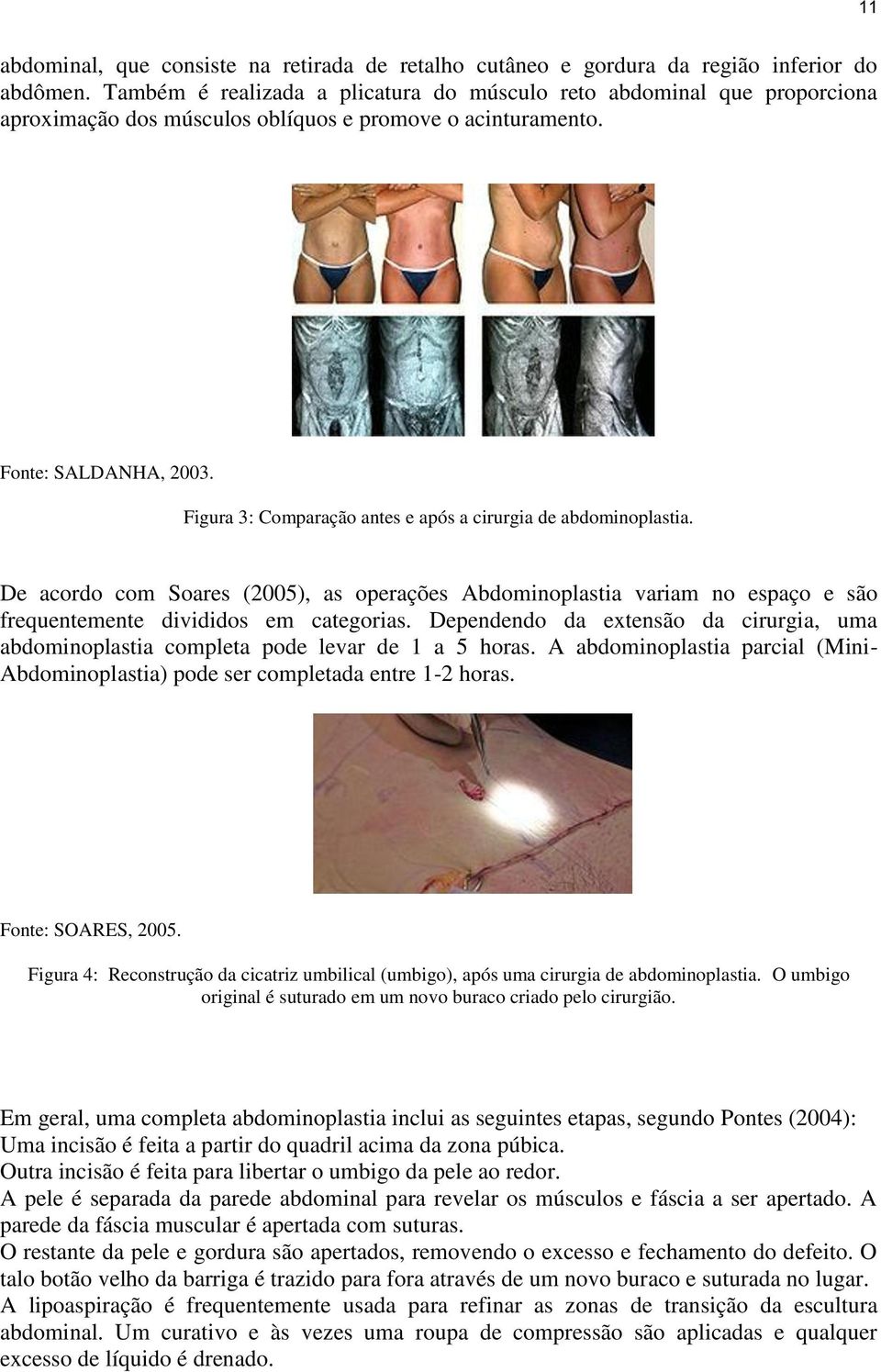 Figura 3: Comparação antes e após a cirurgia de abdominoplastia. De acordo com Soares (2005), as operações Abdominoplastia variam no espaço e são frequentemente divididos em categorias.