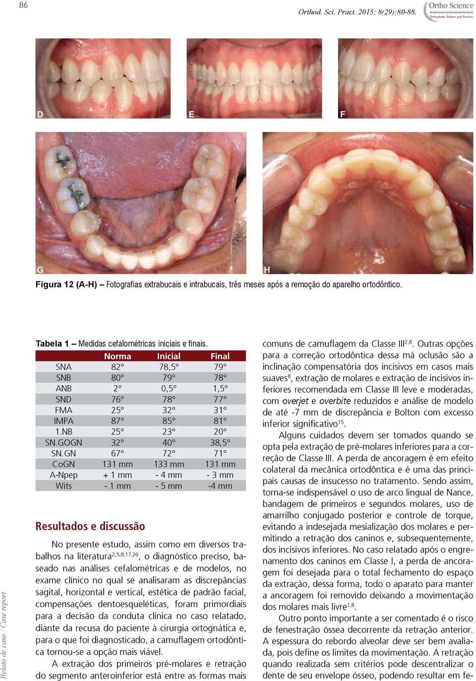 GN 67 72 71 CoGN 131 mm 133 mm 131 mm A-Npep + 1 mm - 4 mm - 3 mm Wits - 1 mm - 5 mm -4 mm Resultados e discussão No presente estudo, assim como em diversos trabalhos na literatura 2,5,8,17,26, o