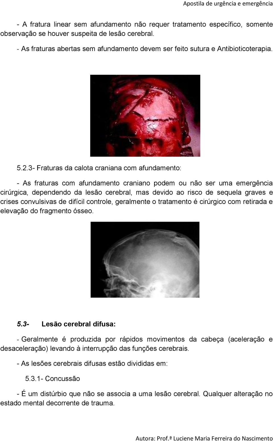 3- Fraturas da calota craniana com afundamento: - As fraturas com afundamento craniano podem ou não ser uma emergência cirúrgica, dependendo da lesão cerebral, mas devido ao risco de sequela graves e