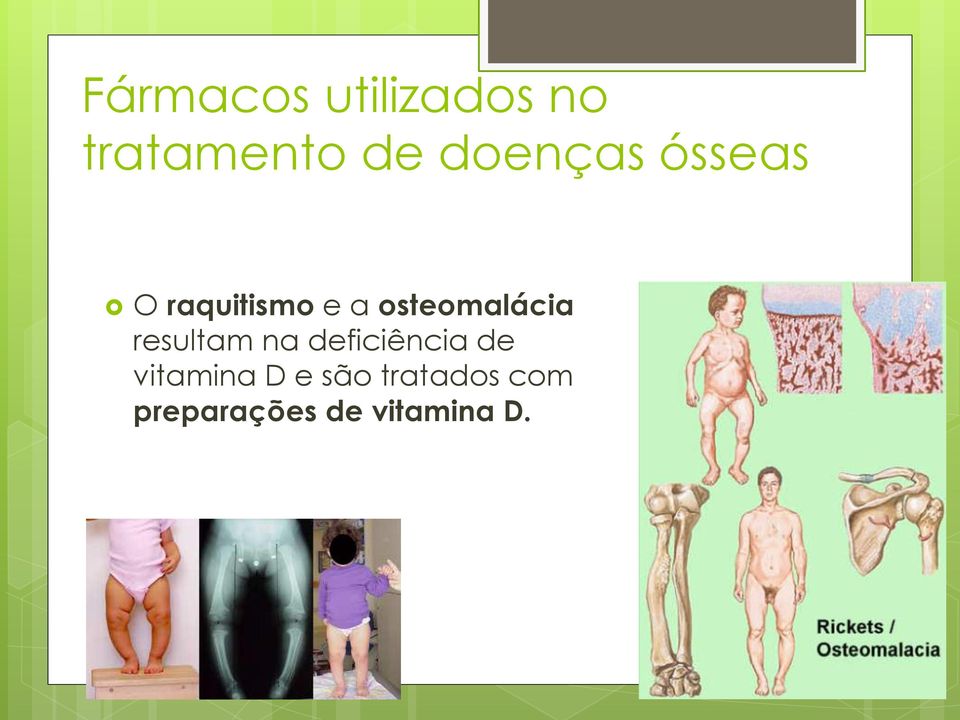 osteomalácia resultam na deficiência de