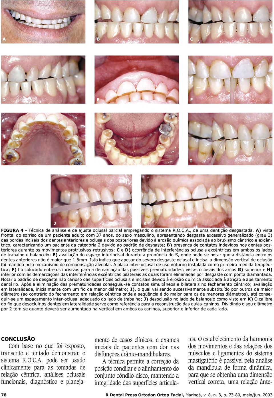 posteriores devido à erosão química associada ao bruxismo cêntrico e excêntrico, caracterizando um paciente da categoria 2 devido ao padrão de desgaste; B) presença de contatos indevidos nos dentes