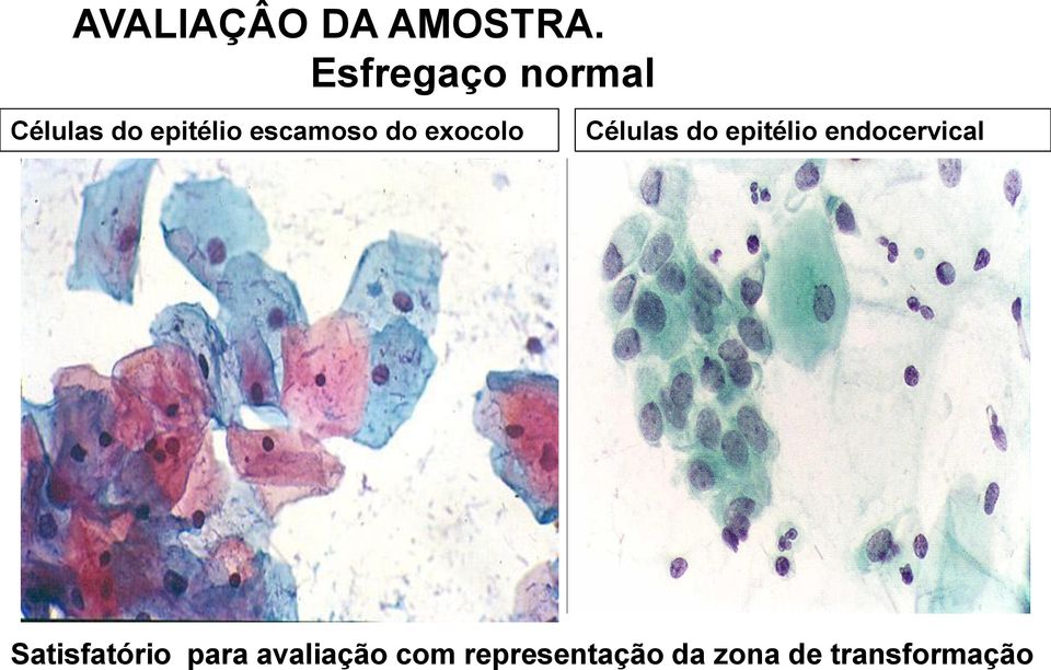 do exocolo Células do epitélio endocervical