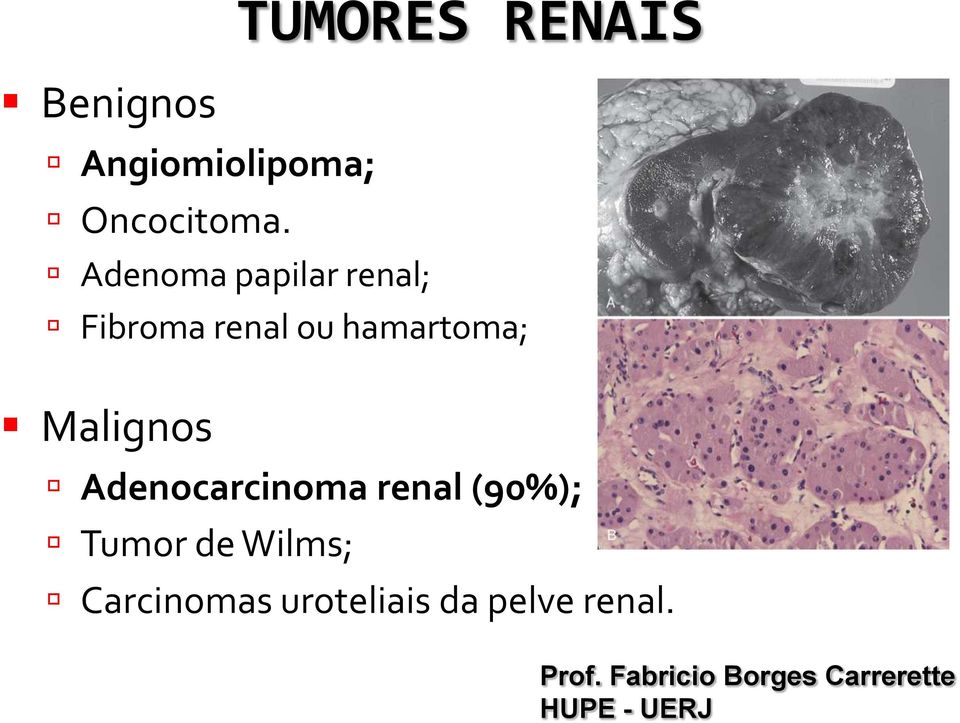 TUMORES RENAIS Adenocarcinoma renal (90%); Tumor de Wilms;