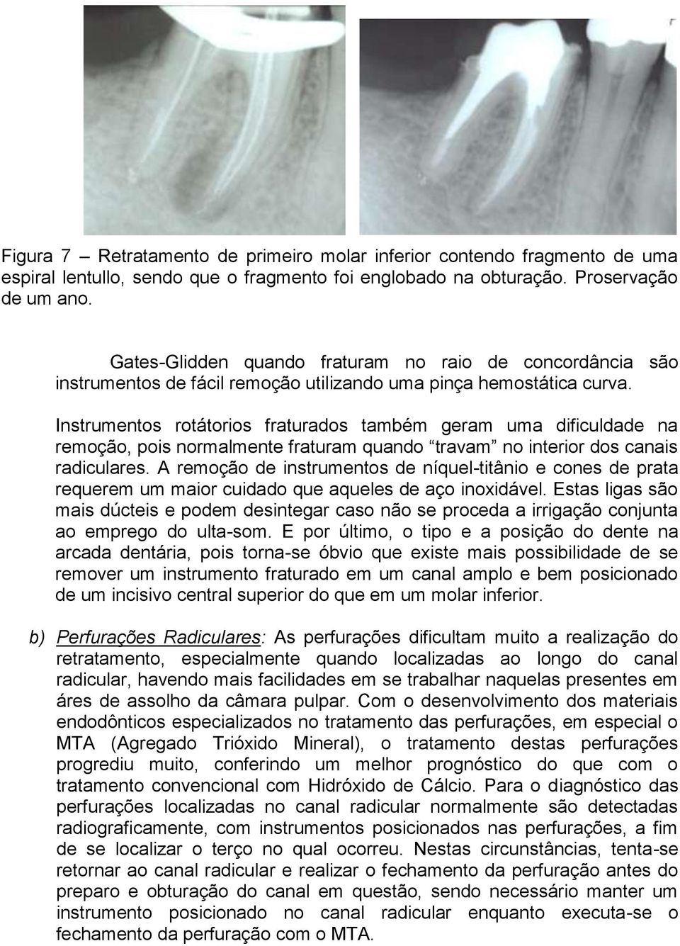 Instrumentos rotátorios fraturados também geram uma dificuldade na remoção, pois normalmente fraturam quando travam no interior dos canais radiculares.