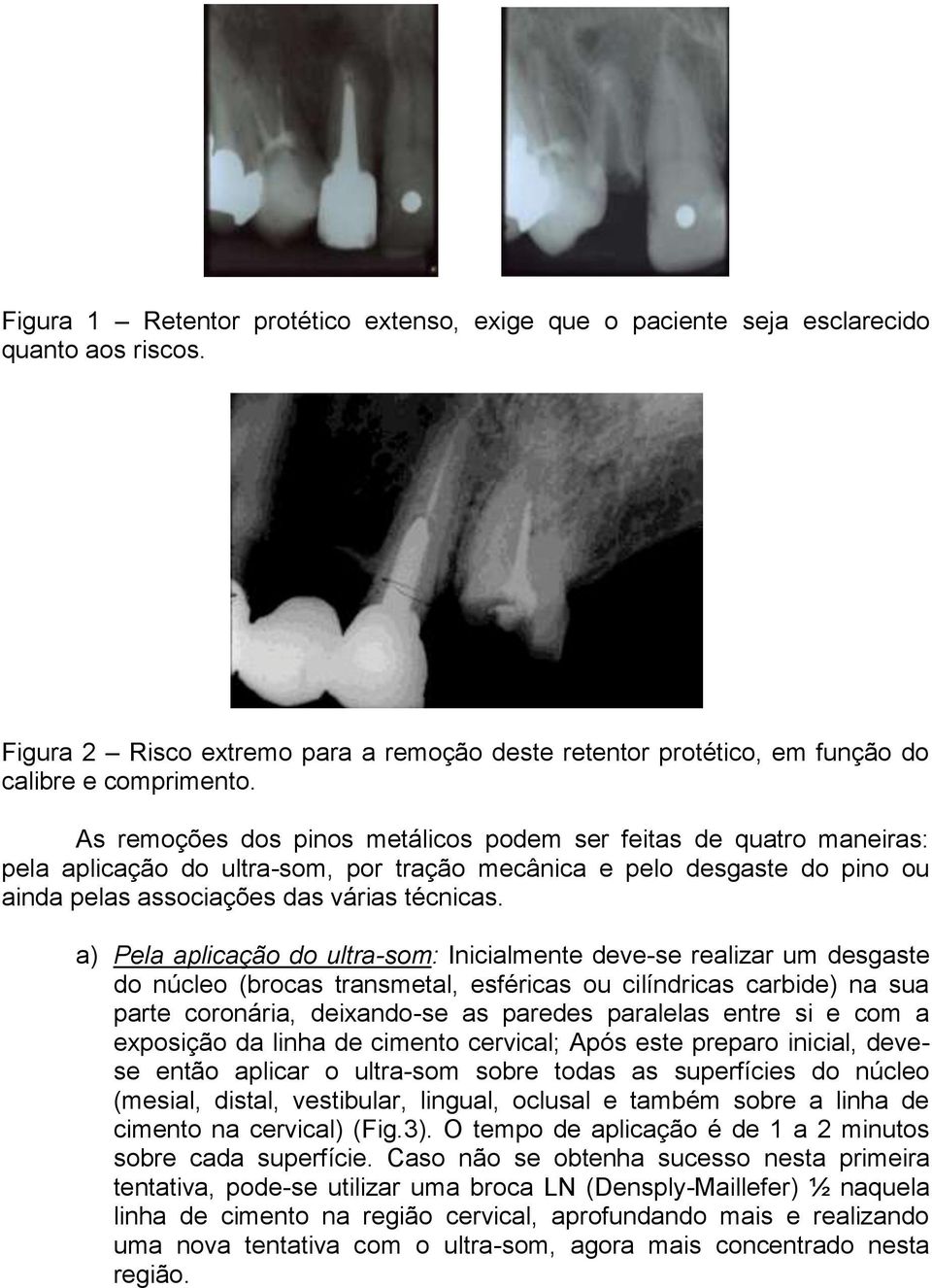 a) Pela aplicação do ultra-som: Inicialmente deve-se realizar um desgaste do núcleo (brocas transmetal, esféricas ou cilíndricas carbide) na sua parte coronária, deixando-se as paredes paralelas