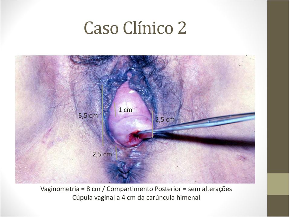 Compartimento Posterior = sem