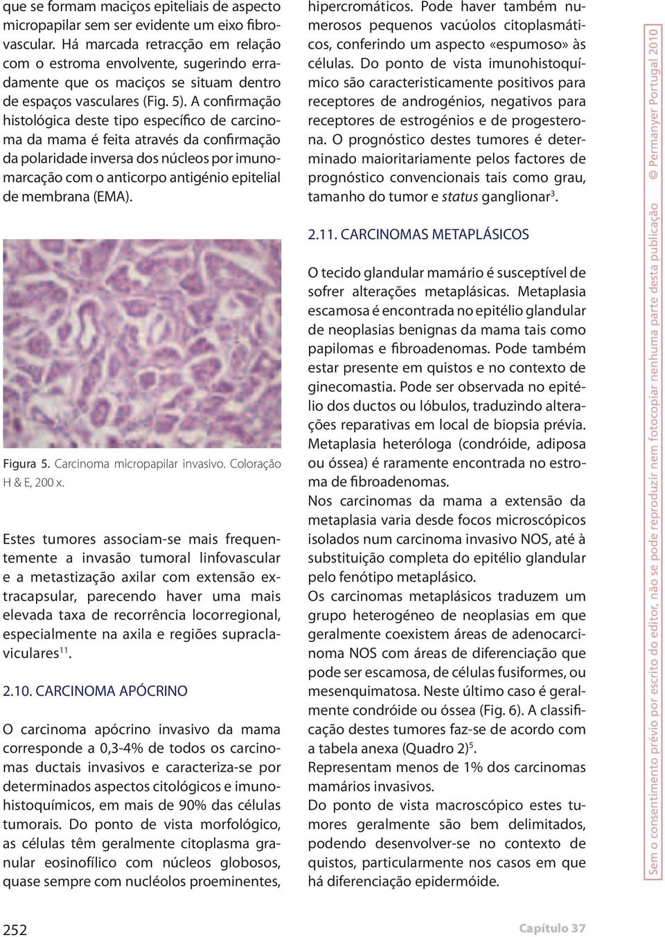 A confirmação histológica deste tipo específico de carcinoma da mama é feita através da confirmação da polaridade inversa dos núcleos por imunomarcação com o anticorpo antigénio epitelial de membrana