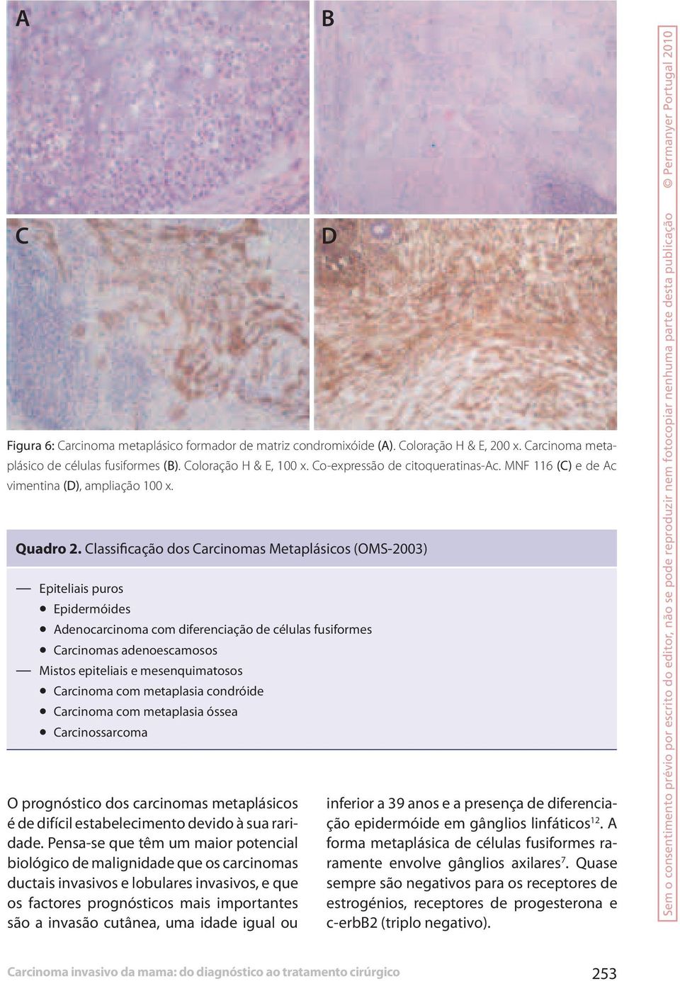 Classificação dos Carcinomas Metaplásicos (OMS-2003) Epiteliais puros Epidermóides Adenocarcinoma com diferenciação de células fusiformes Carcinomas adenoescamosos Mistos epiteliais e mesenquimatosos